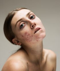 Model Louisa Northcote poses without makeup on