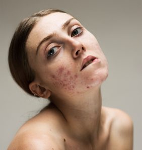Model Louisa Northcote poses without makeup on